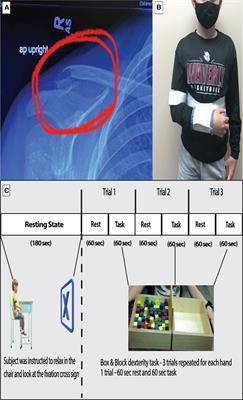 Motor cortical functional connectivity changes due to short-term immobilization of upper limb: an fNIRS case report